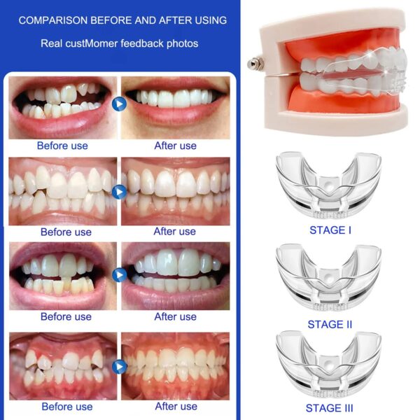 D1 Teeth Corrector/আঁকাবাঁকা দাঁত, উঁচু দাঁত, ফাঁকা দাঁতের সকল সমাধান - Image 6