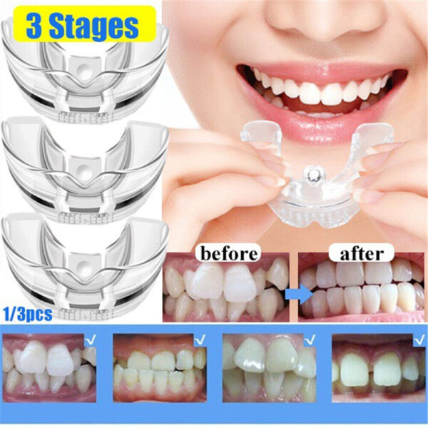 D1 Teeth Corrector/আঁকাবাঁকা দাঁত, উঁচু দাঁত, ফাঁকা দাঁতের সকল সমাধান